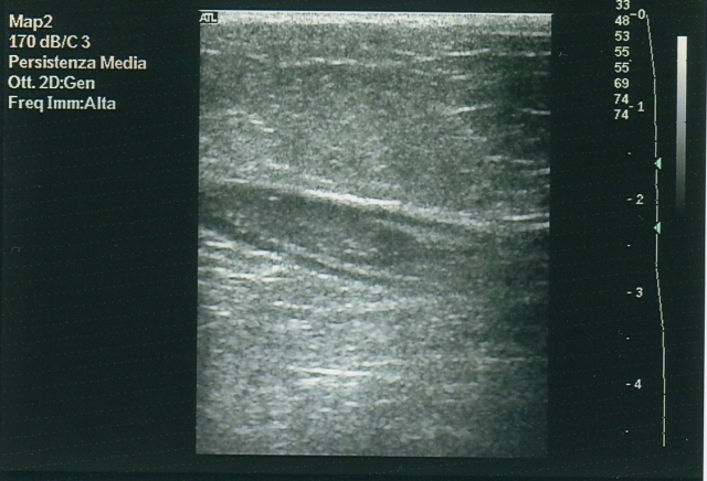 Immagine ecografica di vena trattata con Laser